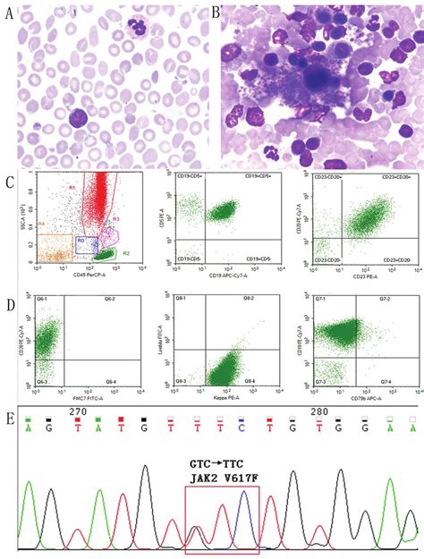 Peripheral blood smear revealed an increased number of typical small ...