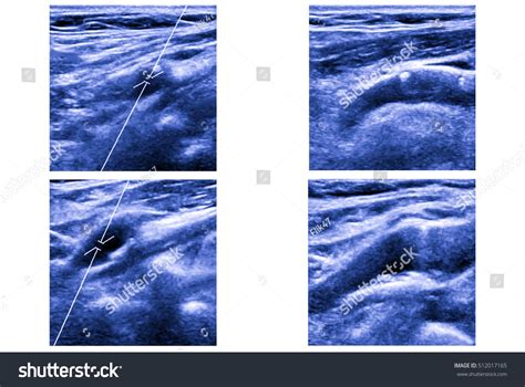 Ultrasound Picture Carotid Artery Arteria Carotis Stockfoto 512017165