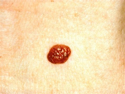 The Complete Guide To Melanoma Symptoms Causes And Cure Boldsky