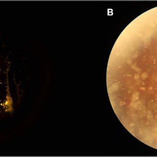 PDF Spotlight On Asteroid Hyalosis A Clinical Perspective