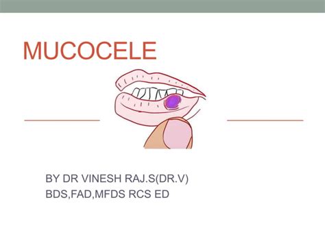 Mucocele Ppt