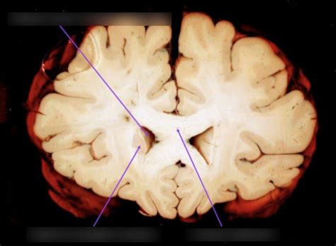 Diagram Of Neuroanatomy Coronal Section Of The Brain Level Quizlet