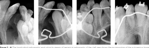 Figure From Reconstruction Of Alveolar Cleft With Allogenous Bone