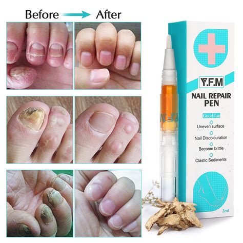 Fungal Nail Treatment Pen Antifungal Care Effective Anti Fungus