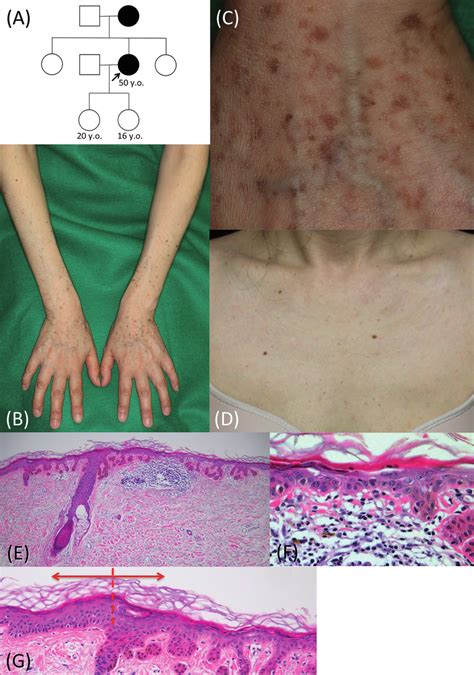 The Clinical And Histopathological Features Of The Patient A The Download Scientific Diagram