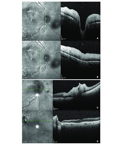 Optical Coherence Tomography In Patients With Giant Cell Arteritis