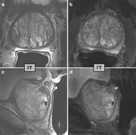 T 2 W Imaging Of The Prostate In Two Orientations Axial A B And Download Scientific Diagram