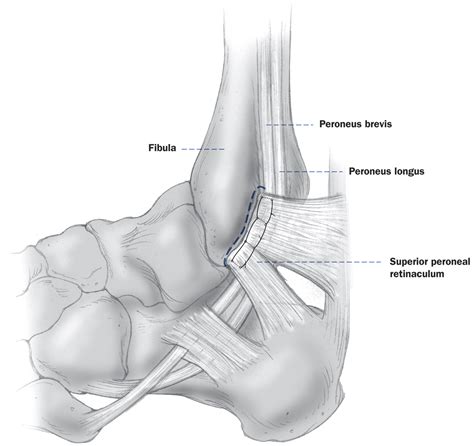 The Daily Educational Pearl Superior Peroneal Retinaculum Tear