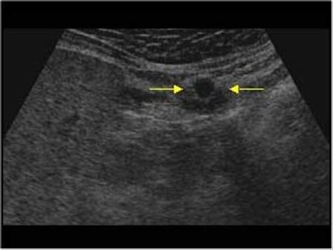 Umbilical Vein Ultrasound