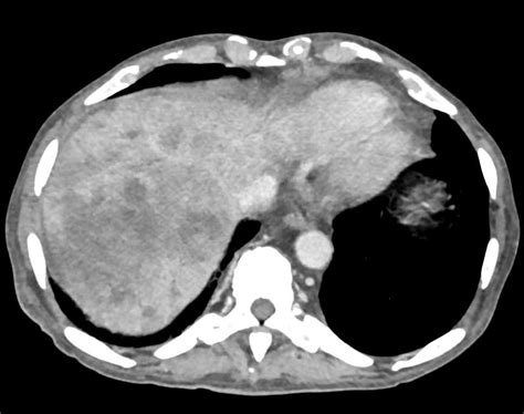 Metastatic Neuroendocrine Tumor To The Liver With Dual Phase Scanning