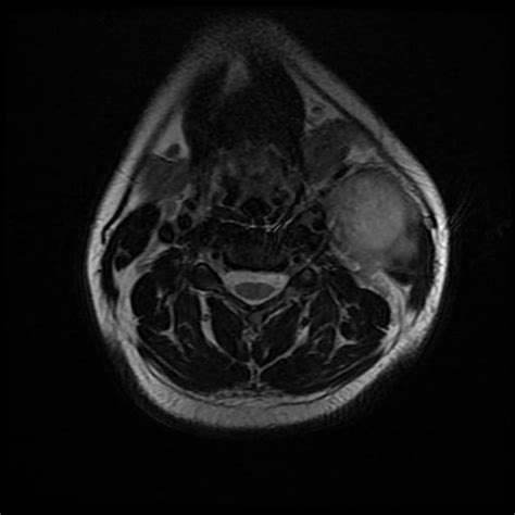 Infected Second Branchial Cleft Cyst Image