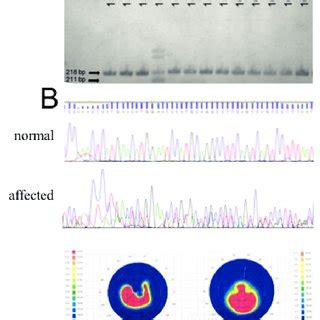 Mutation Taster analysis of SOD1 promoter nucleotide variations ...