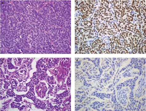 A D Cases Of Ovarian Granulosa Cell Tumors Adult Type Showing