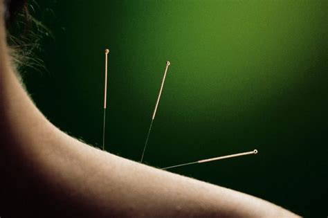 Acupuncture For Neck Pain A Comprehensive Guide Acusports Therapy