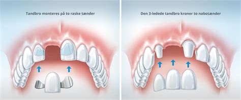 Tandimplantater Og Tandbroer Tandl Ge I Slagelse