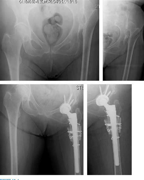 Figure 19 3 From Part Iv Complex Primary Total Hip Arthroplasty