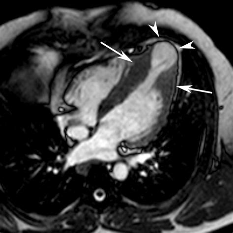 Mr Imaging In Hypertrophic Cardiomyopathy From Magnet To Bedside