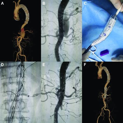 Use Of 3d Printed Model To Guide Fenestrated Stent Graft Repair Of A Download Scientific