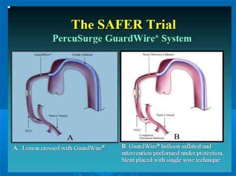 Saphenous Venous Graft Interventions Ppt