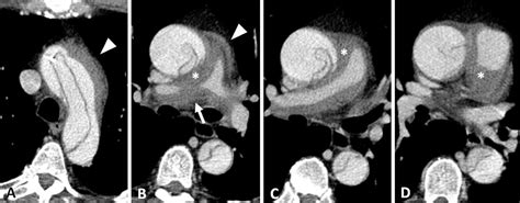 Pulmonary Arterial Intramural Hematoma Due To Acute Aortic Dissection