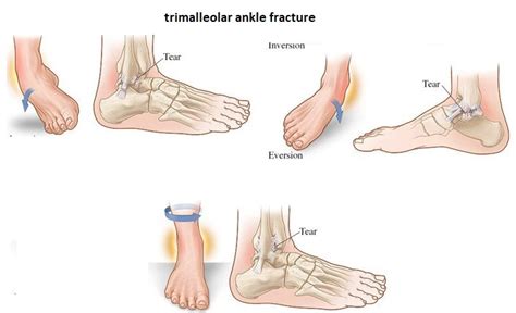 Displaced Trimalleolar Ankle Fracture