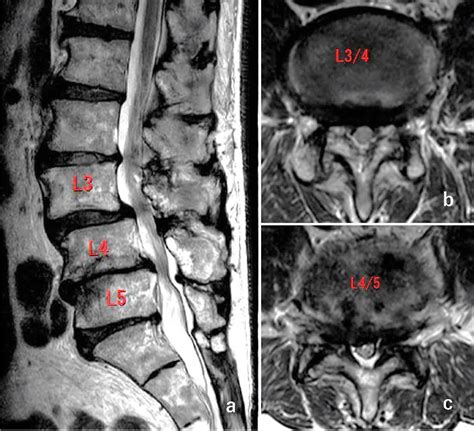 Figure 1 From Double Crush Of L5 Spinal Nerve Root Due To L45 Lateral