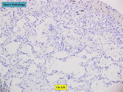 Qiao S Pathology Metastatic Gastric Signet Ring Cell Carc Flickr