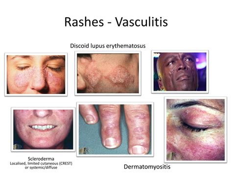 Allergic Vasculitis Rash