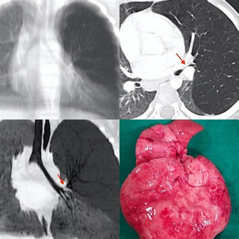 Congenital Lobar Emphysema CLE REF India