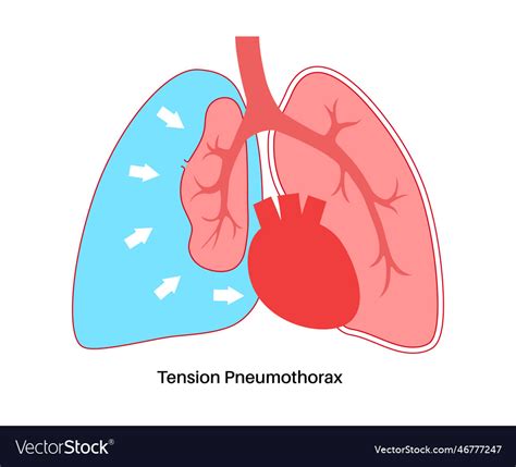 Tension Pneumothorax Poster Royalty Free Vector Image