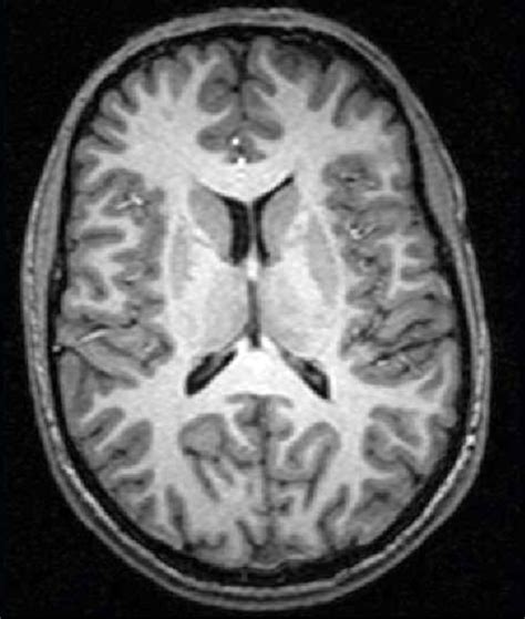 Level Of Thalamus Mri Diagram Quizlet