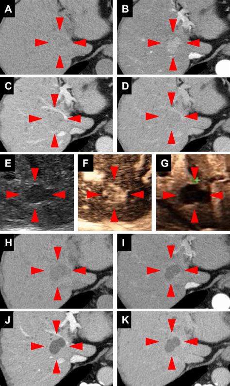 Abdominal Contrast Enhanced Computed Tomography Cect A D And