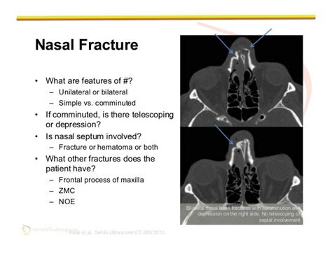 Nasal Bone Anatomy Scan Radiology Anatomy Images Ct Frontal Sinuses