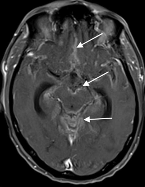 Neoplastic Meningitis And Paraneoplastic Syndromes Radiology Key