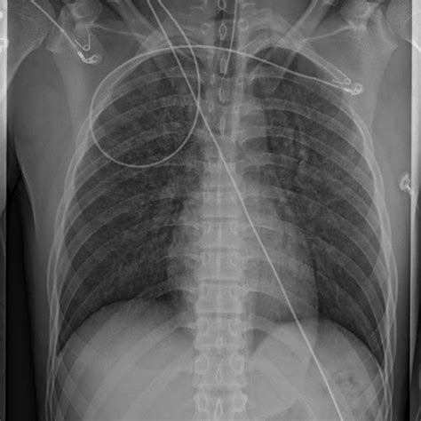 Portable Chest Anteroposterior Radiograph Obtained 17 Minutes After