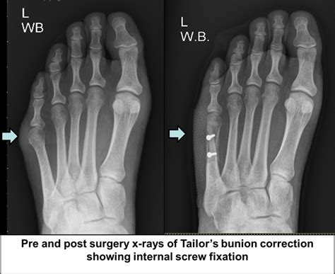 Bunion Surgery