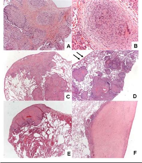 Figure 1 From The Histology Of Pulmonary Sarcoidosis A Review With Particular Emphasis On