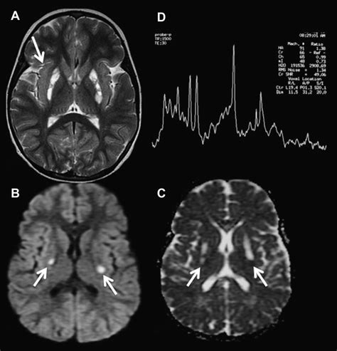 Leigh Syndrome High Signal Areas On The Putamen Are Visualized By