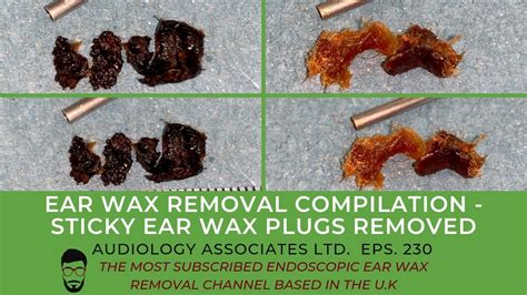 Ear Wax Removal Compilation Sticky Ear Wax Plugs Removed Ep 230 Youtube