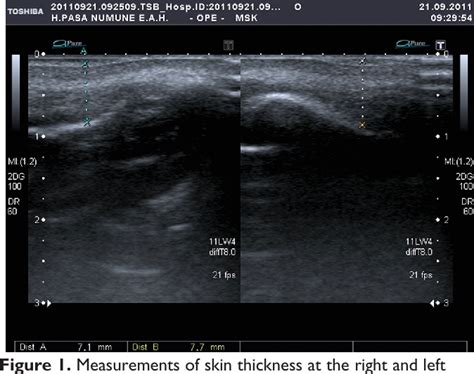 Figure 1 from Effect of Nose Skin on the Columellar Incision Scar in a Turkish Population ...