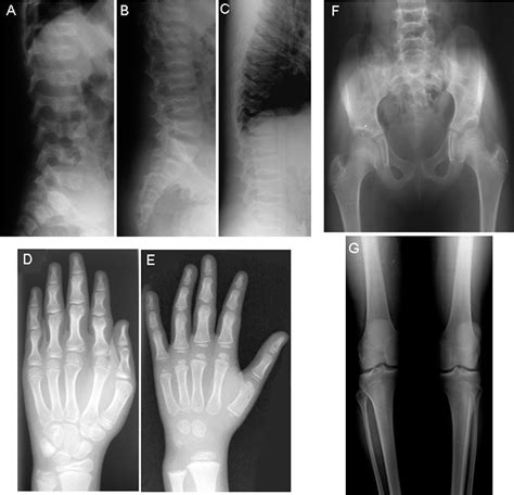 Figure From Spondylocheiro Dysplastic Form Of The Ehlers Danlos