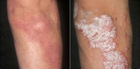 Psoriasis: new treatments, excellent results | MSR News Online