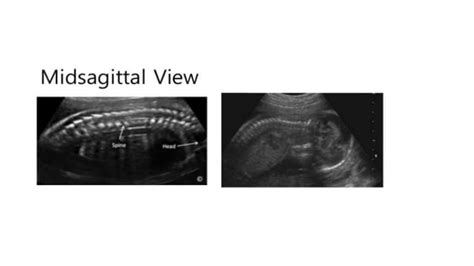 Fetal Biometry Parameters Lk Ppt