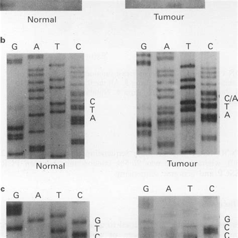 Genomic Sequencing Of Exons 5 8 Of The P53 Gene In Human Breast Download Scientific Diagram