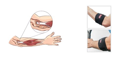 Medial Epicondylitis Diagnosis And Treatment