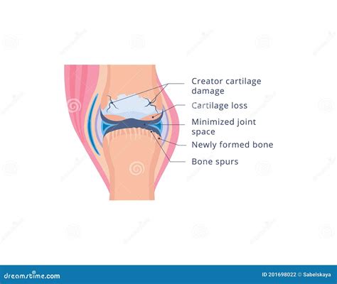 Knee Joint Damage with Osteoarthritis, Flat Vector Illustration ...