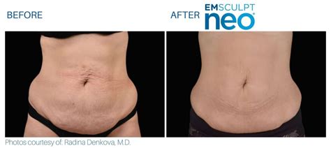 Emsculpt NEO Before And After Real Patient Results