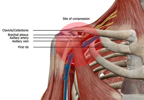 Thoracic Outlet Syndrome Five Dock Osteopathic And Chiropractic Centre