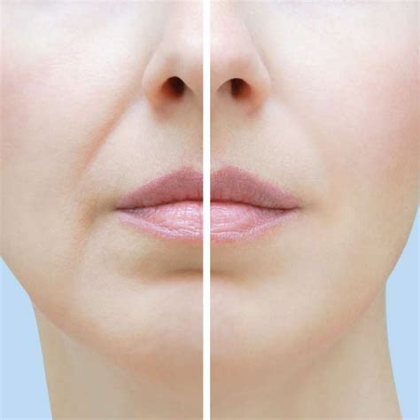 Keep Smiling And Looking Sexy With The Nasolabial Folds Filler