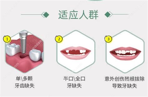 呼市华医口腔医院种植牙收费现搞活动种植一颗牙价格3680 口腔资讯 牙齿矫正网